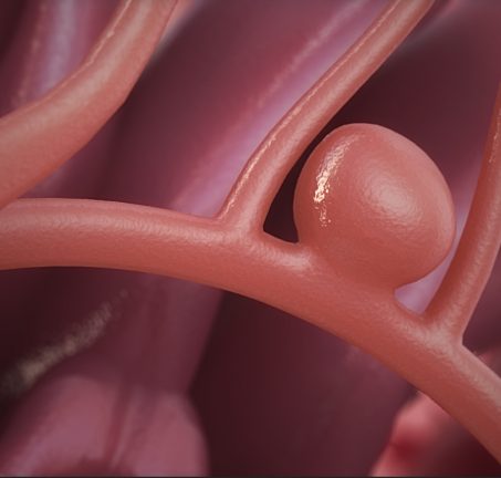 Brain Aneurysm