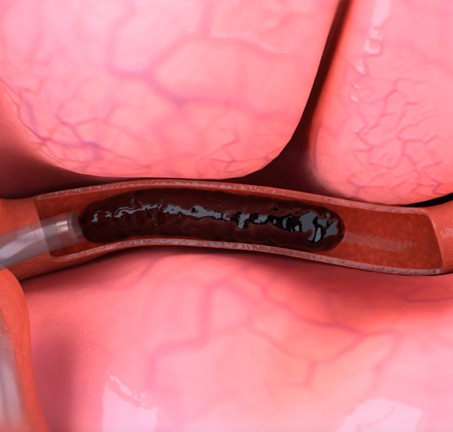 Acute Ischemic Stroke