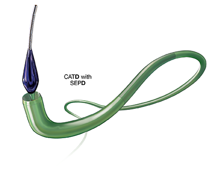 Indigo System Catheters & Separators