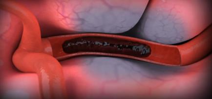Health: Global Campaigns Highlight Thrombosis and Stroke Awareness