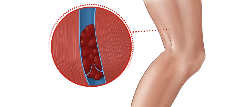 image of a leg with a detail of a clot in a blood vessel