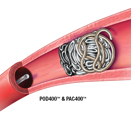 POD400<sup>™</sup> & PAC400<sup>™</sup> Large Volume Coils
