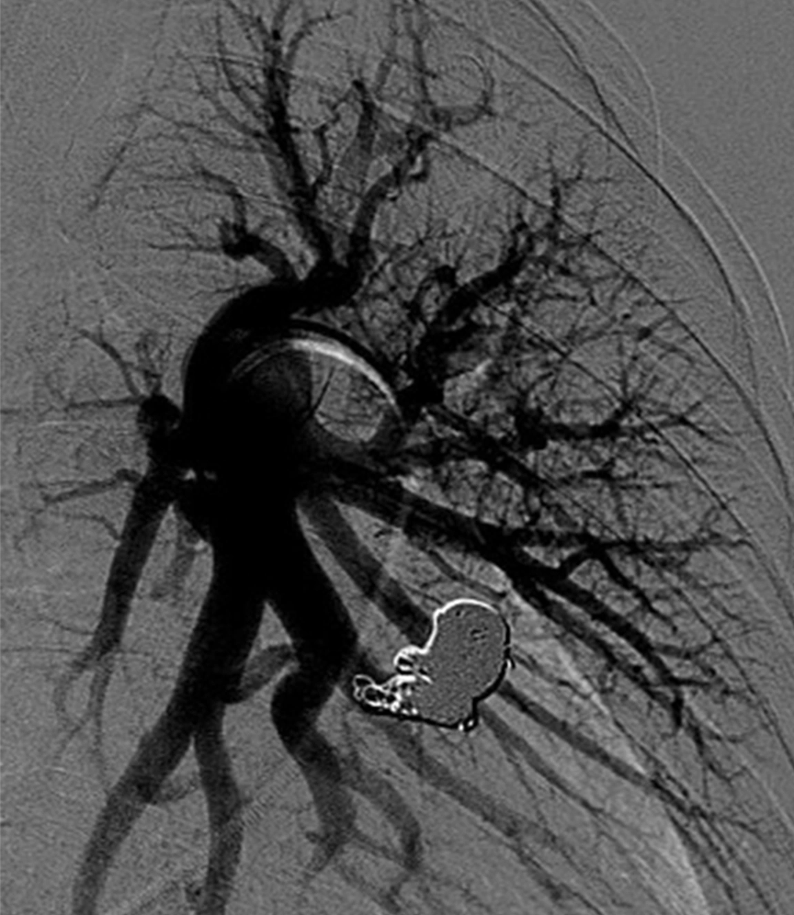 Angiogram of occluded pulmonary arteriovenous malformation with Ruby coils