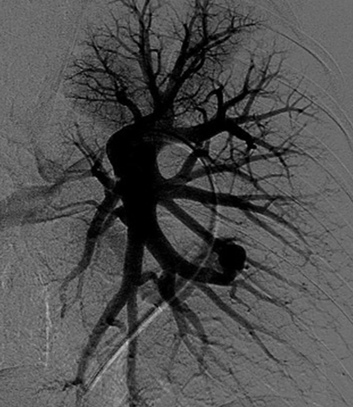Angiogram of pulmonary arteriovenous malformation