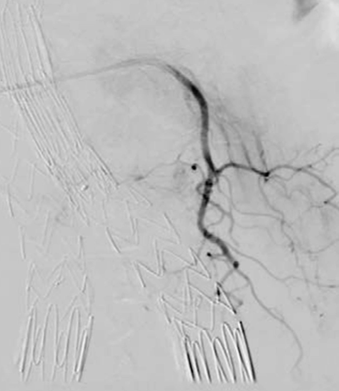 Angiogram of Type III Endoleak