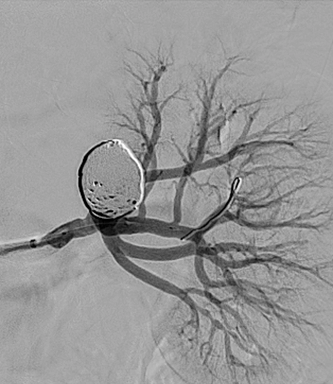 Angiogram of occluded renal artery aneursym with Ruby coils
