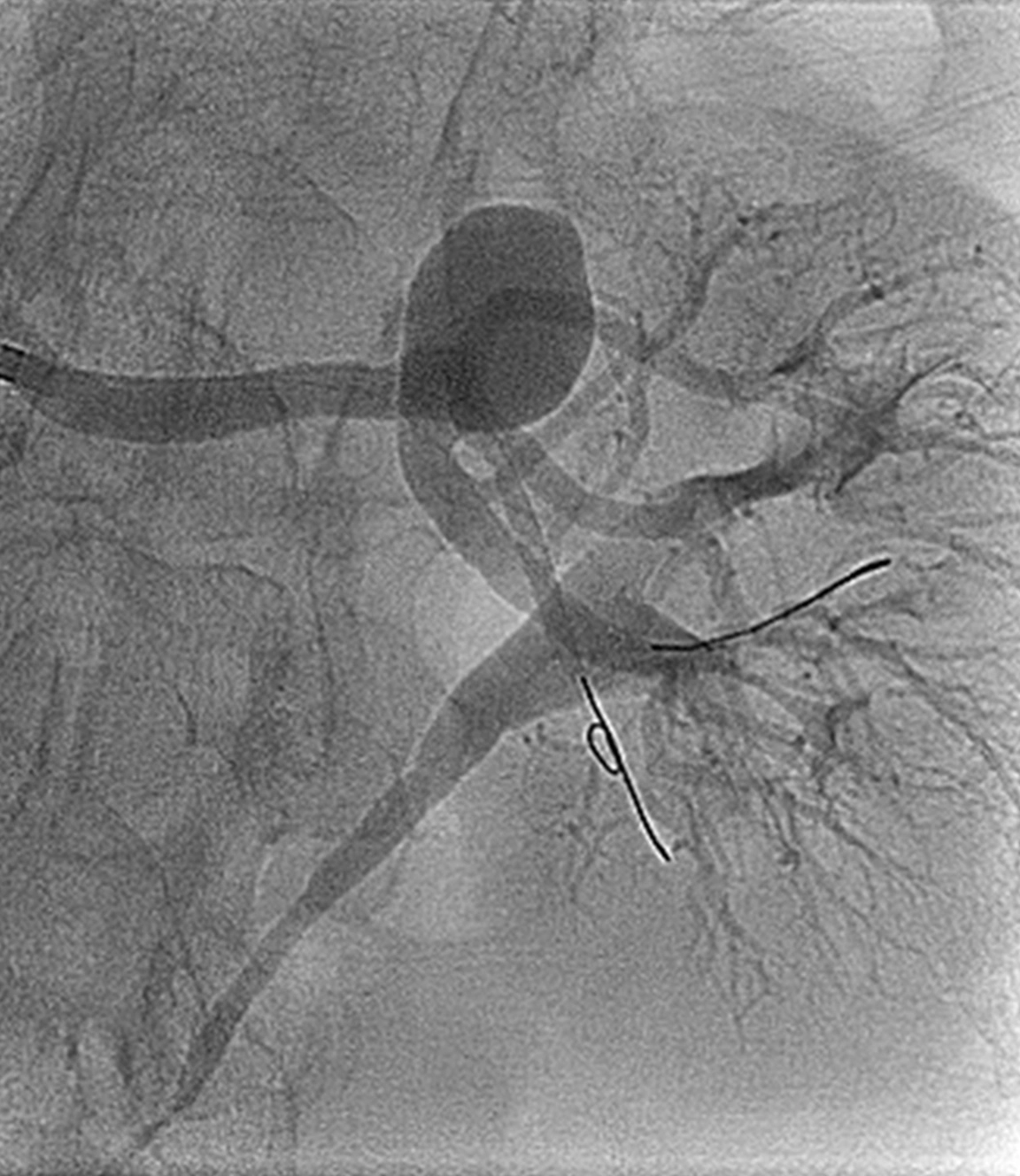 Angiogram of renal artery aneursym