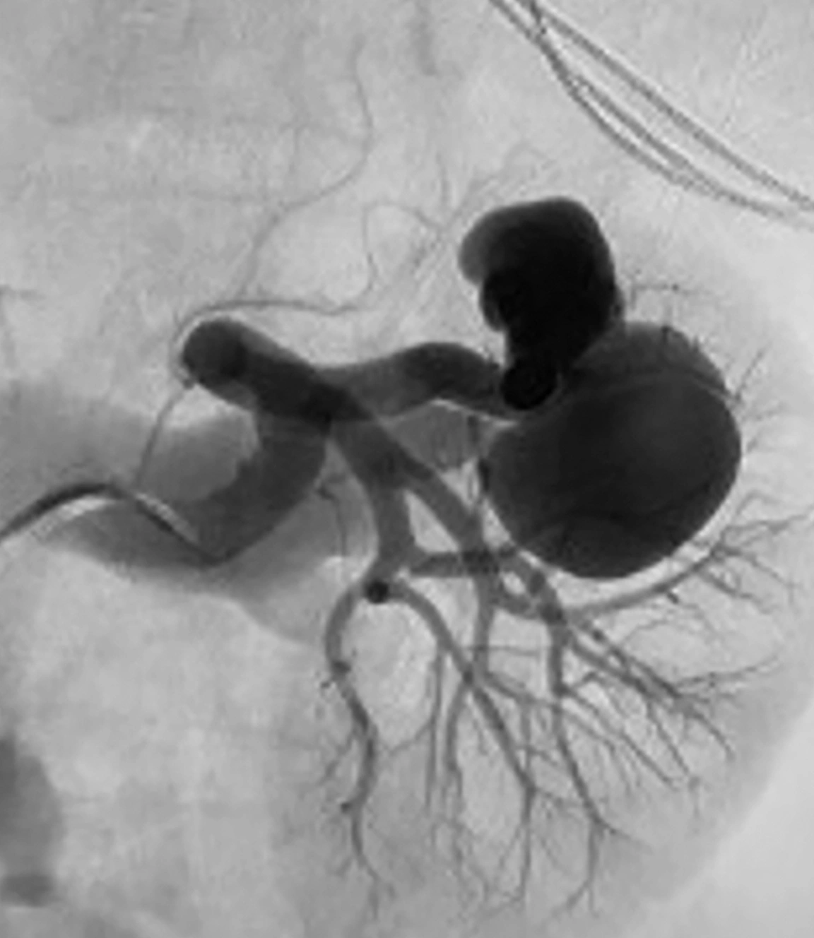 Angiogram of renal arteriovenous malformation