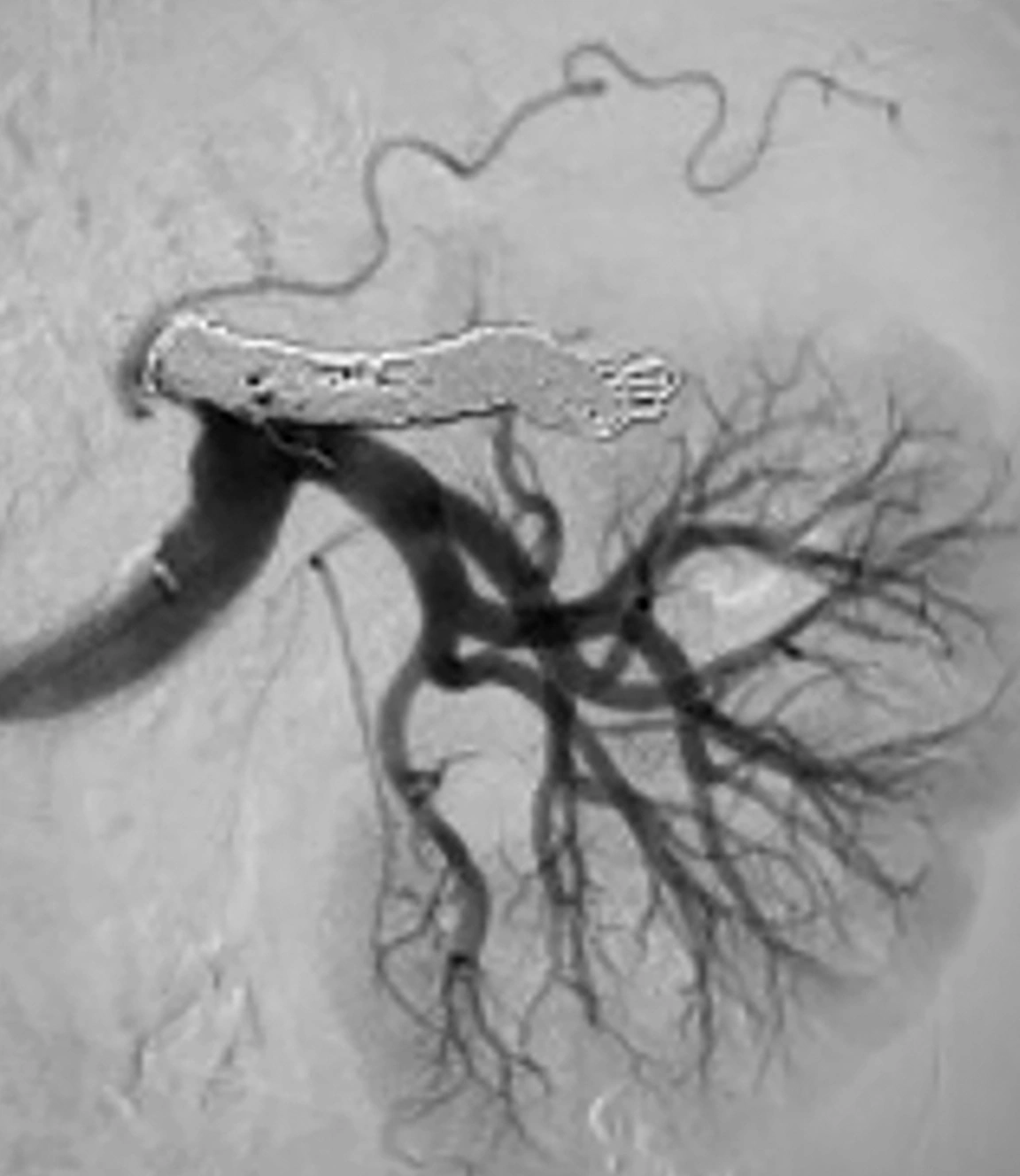 Angiogram of coil pack in renal arteriovenous malformation embolized with POD coils