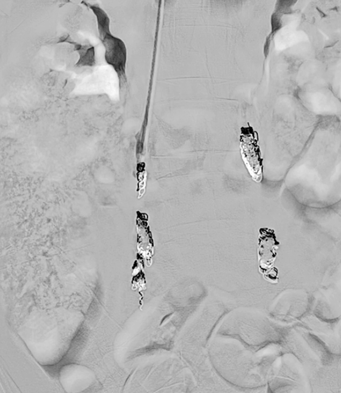 Angiogram showing embolization with Packing Coils to treat pelvic congestion