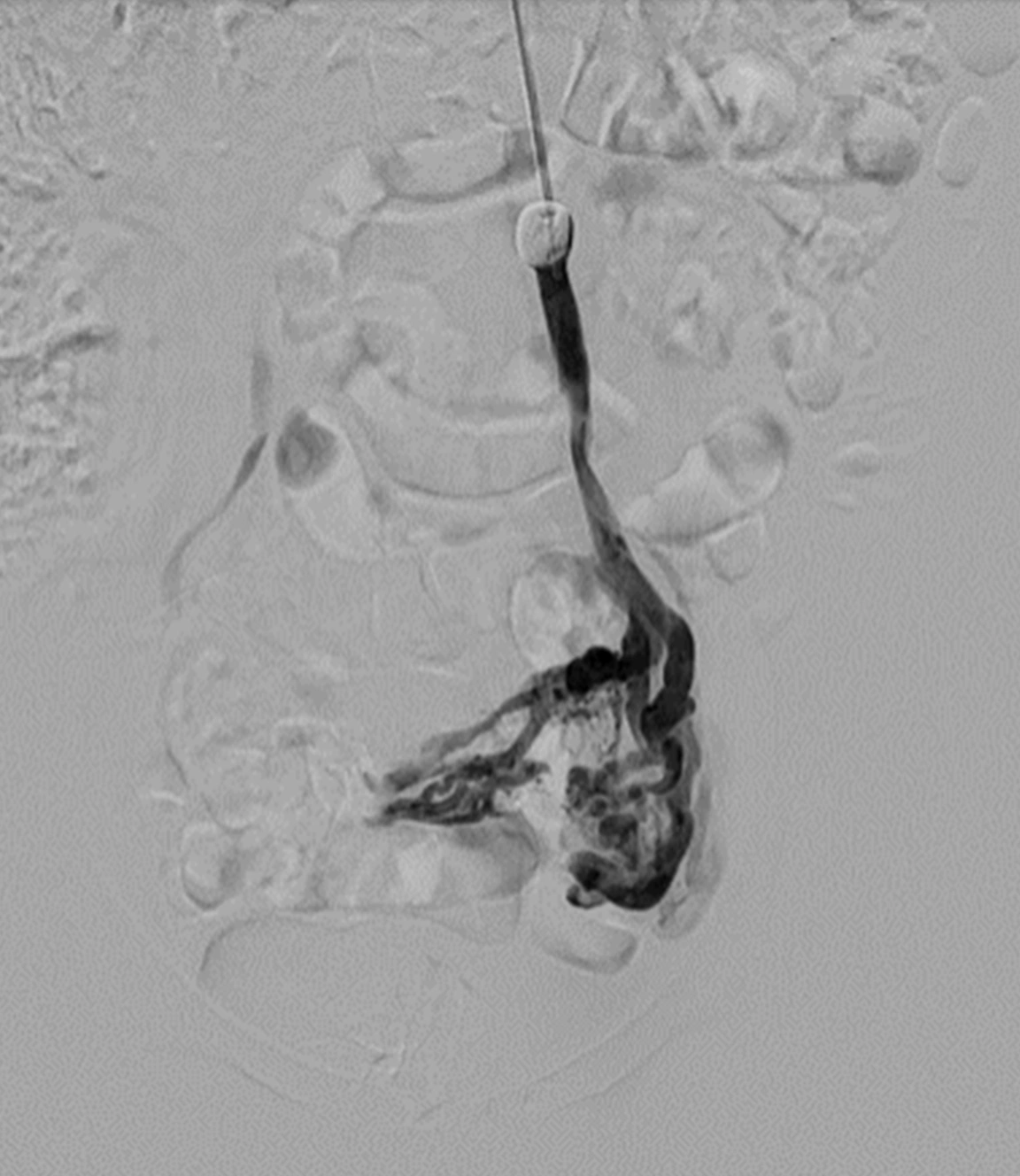 Angiogram showing pelvic congestion syndrom prior to embolization