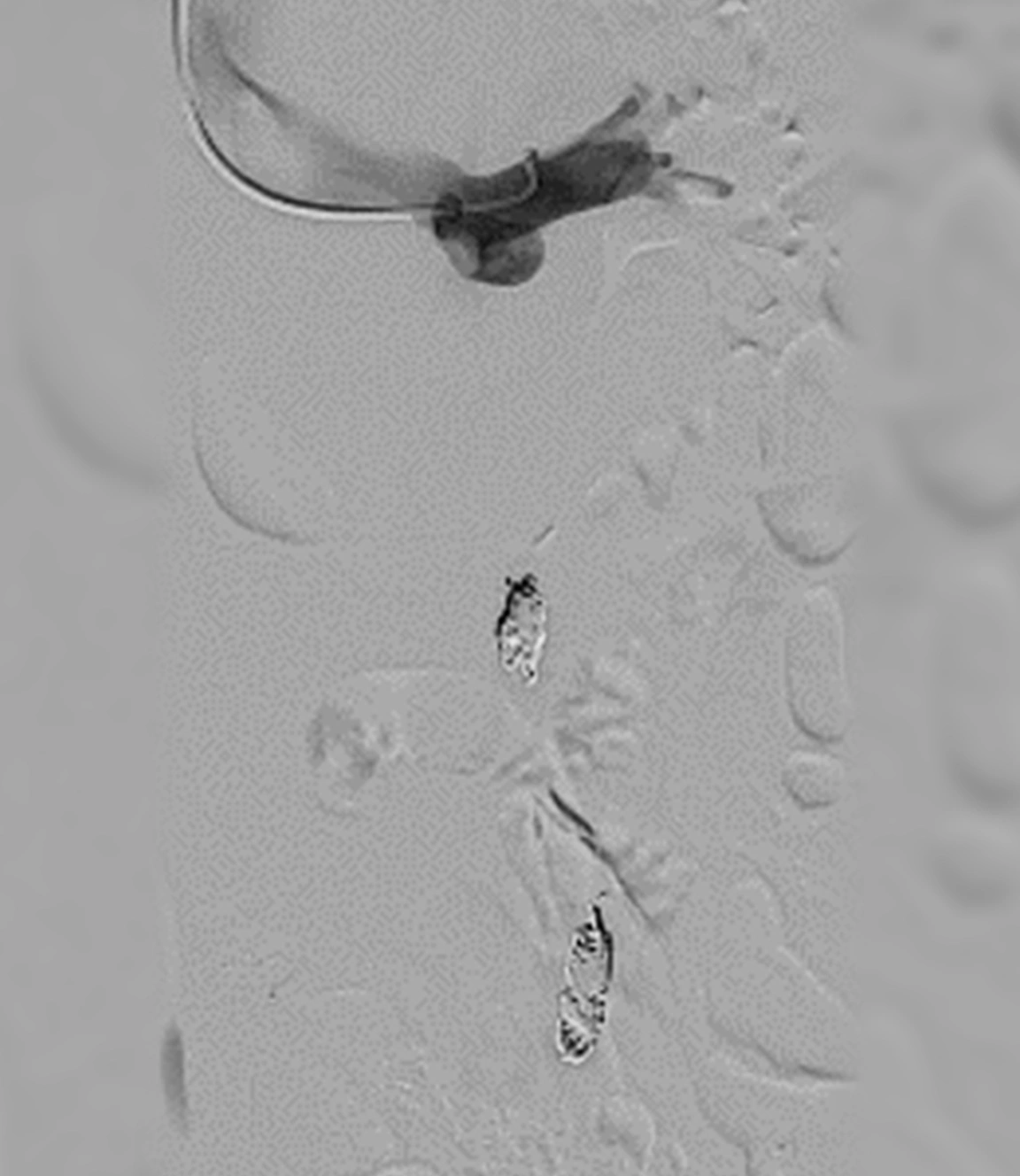 Angiogram of occluded pelvic venous disorder with POD coils