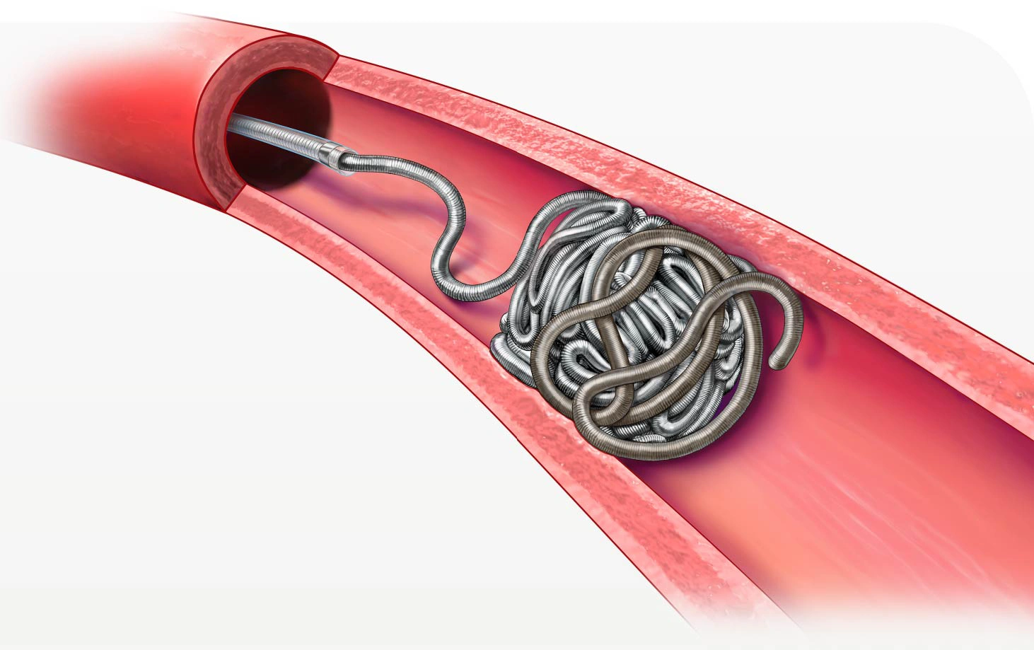 Illustration of POD embolization system packed and placed in a vessel within the body