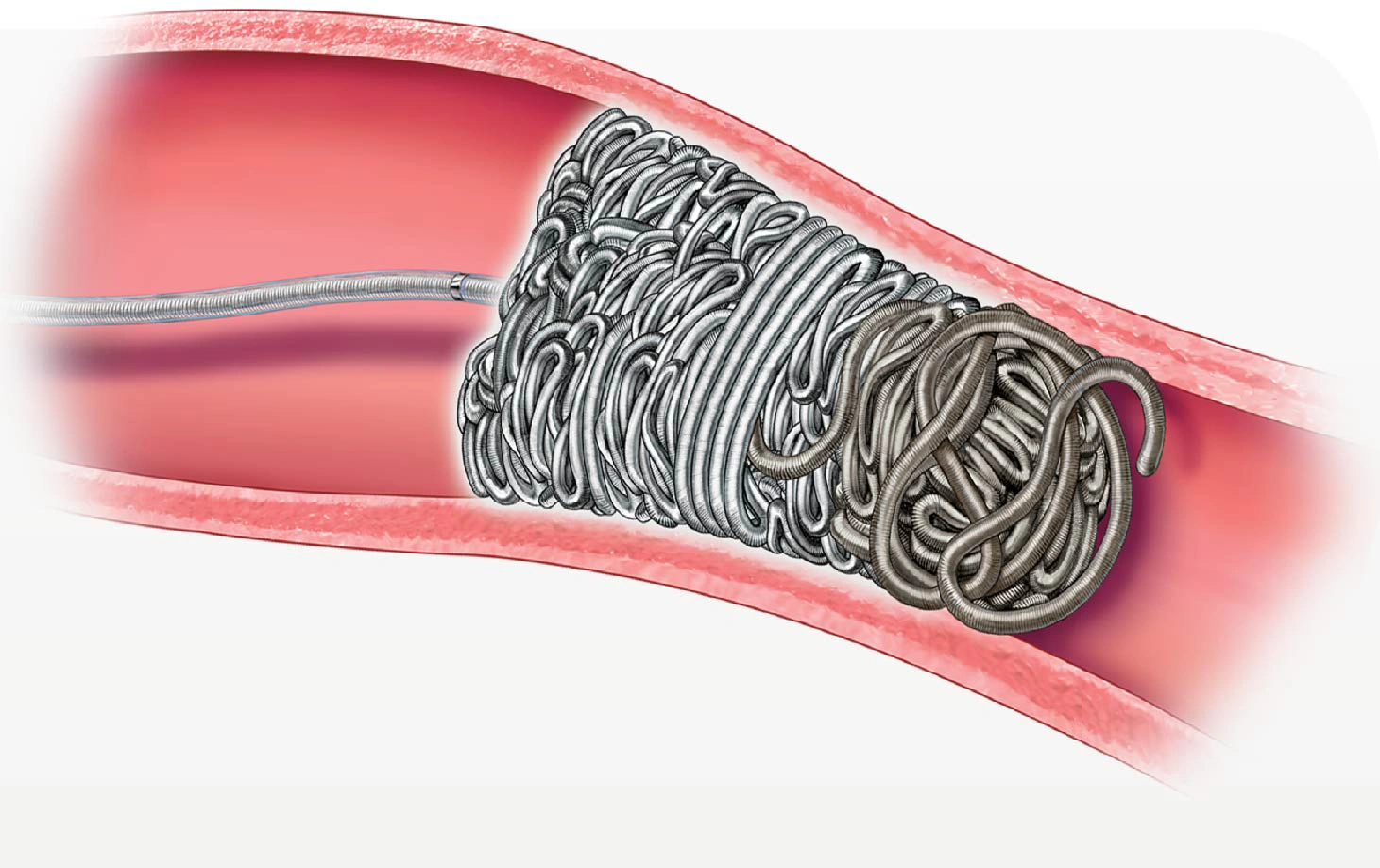 illustration of packing coil placed in a vessel in the body