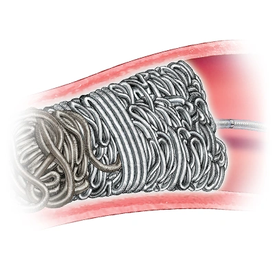 illustration of packing coil placed in a vessel in the body