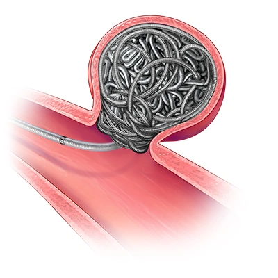 Illustration of Ruby coil system in the body