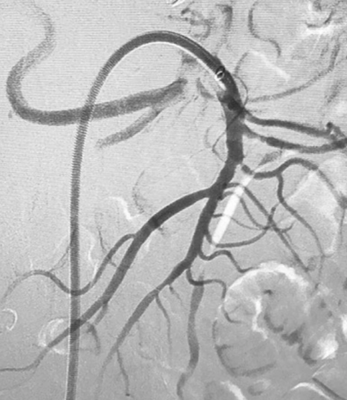 Angiogram of restored blood flow through SMA post computer-aided thrombectomy with Lightning 7