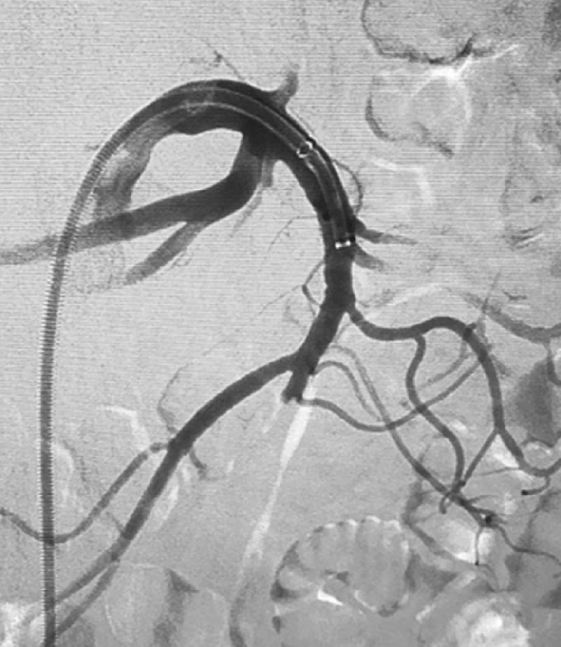Angiogram of occluded blood flow through Superior Mesenteric Artery