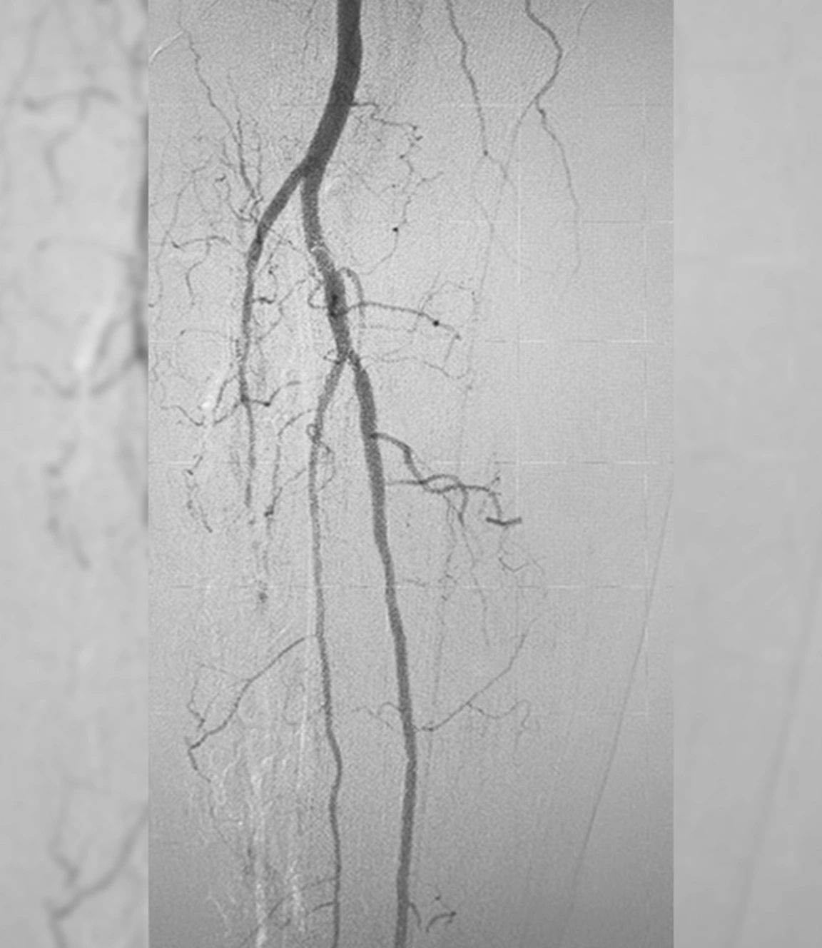 Angiographic image of restored blood flow through popliteal artery post computer-aided thrombectomy with Lightning 7