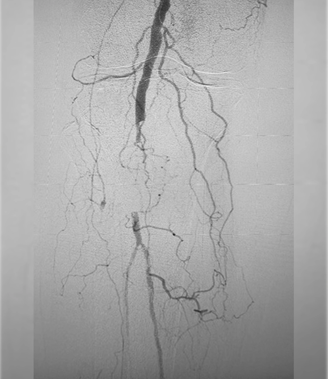 Angiographic image of occluded popliteal artery