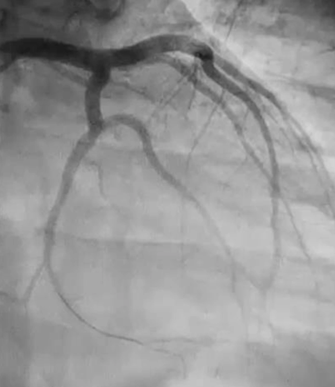 Angiogram of restored flow in left circumflex artery after CAT RX clot removal