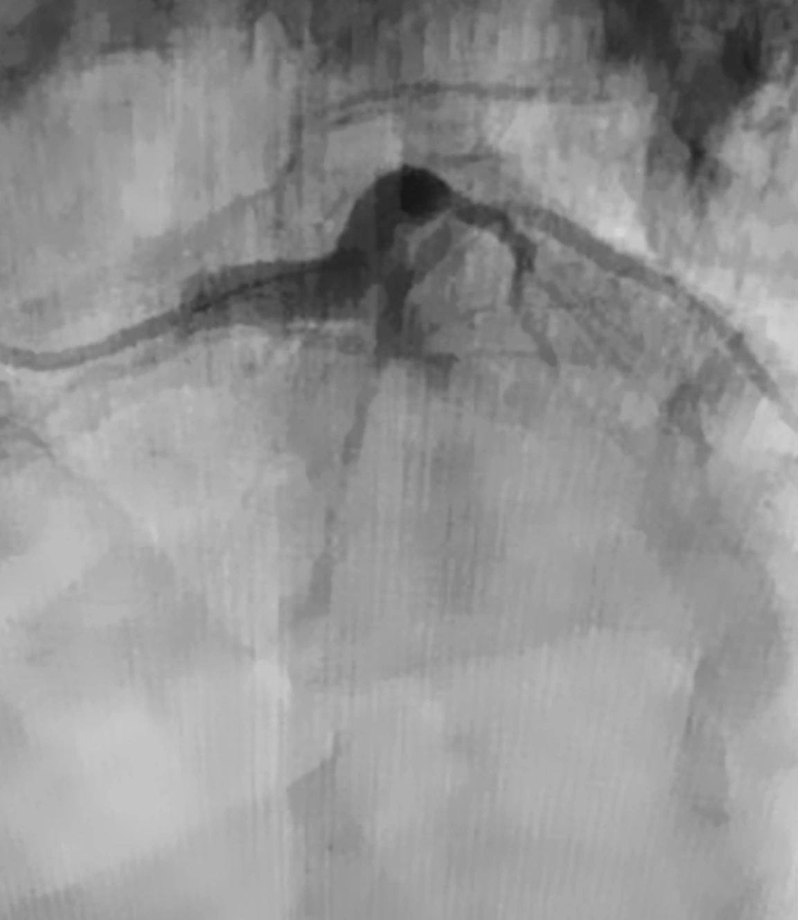 Angiogram of clot occlusion in left circumflex artery before CAT RX