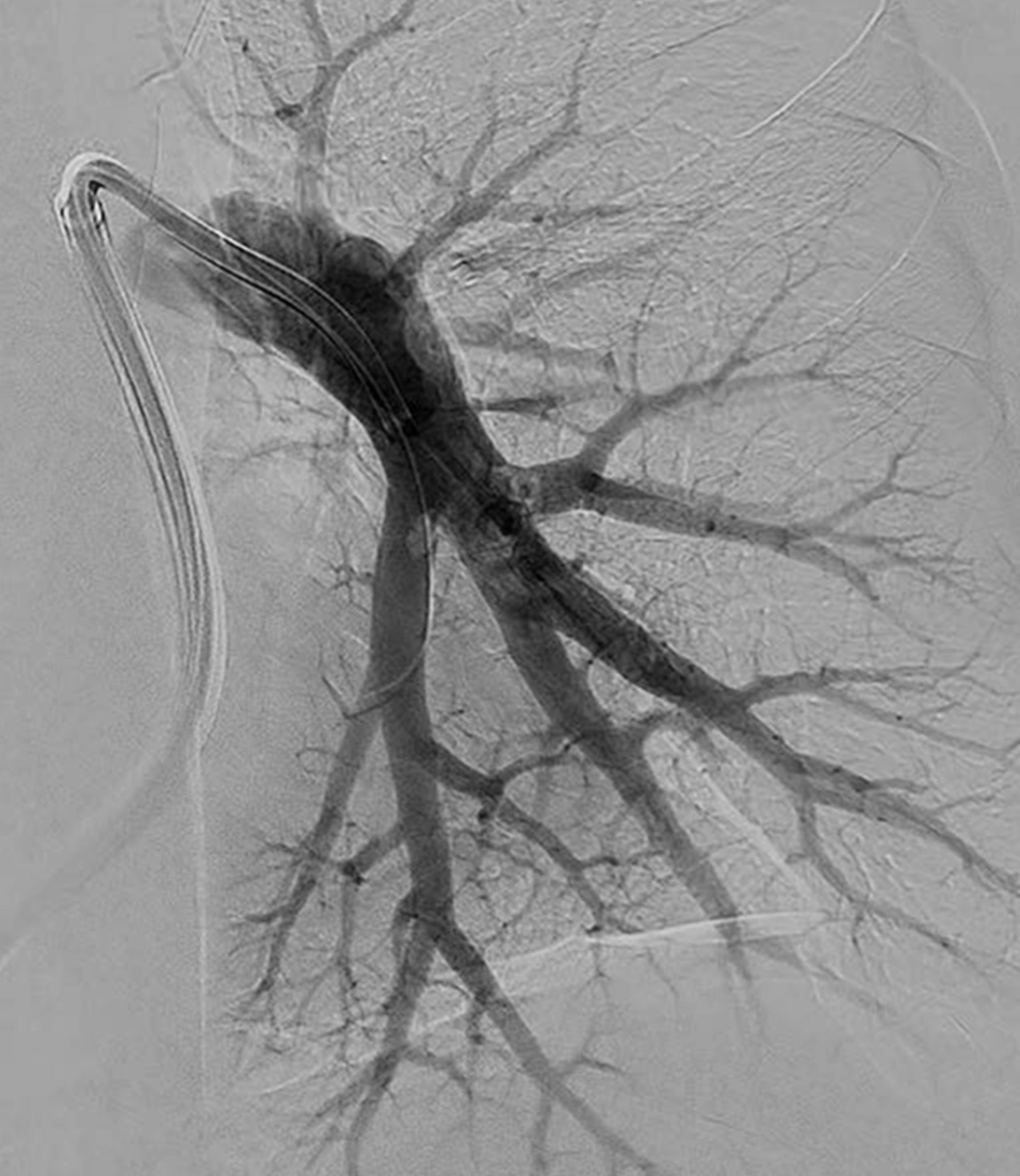 Angiogram of restored blood flow in left lung post computer-aided thrombectomy with Lightning 12