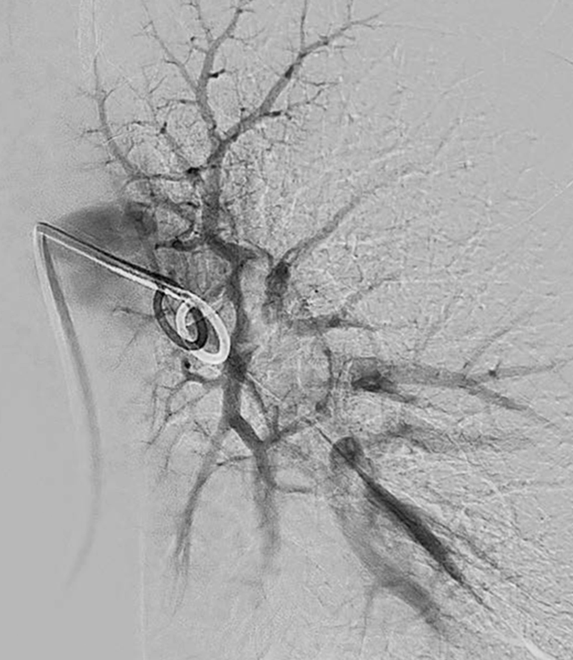 Angiogram of left lung with pulmonary embolism