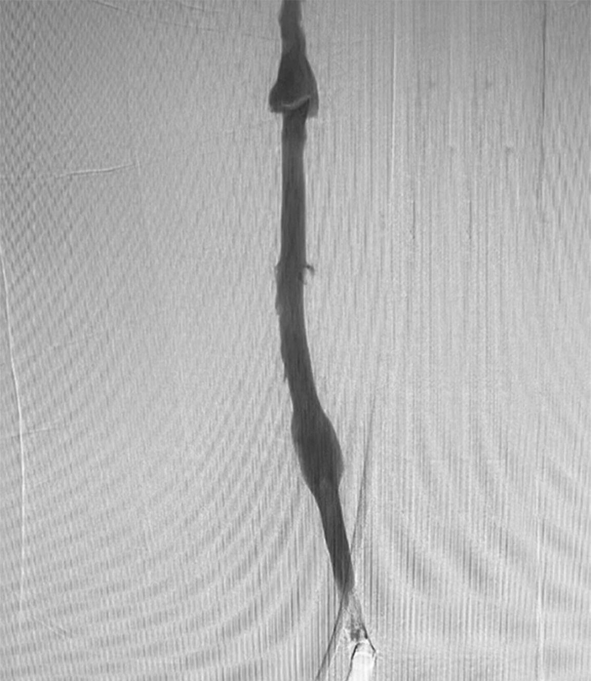 Angiogram of restored blood flow post thrombectomy with Lightning 12