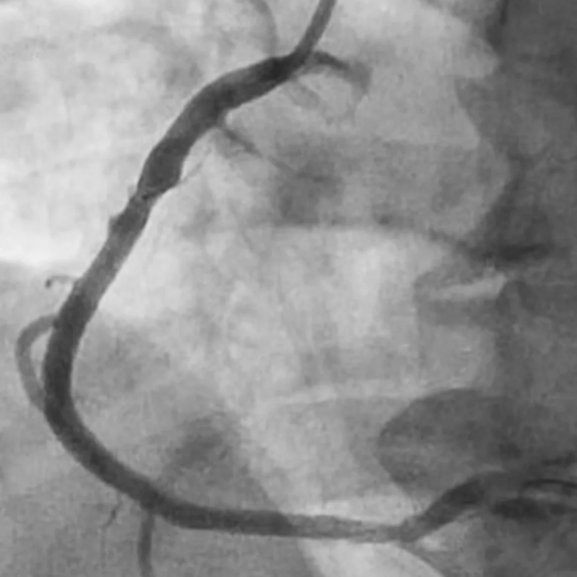 Angiogram of restored flow in right coronary artery after CAT RX clot removal