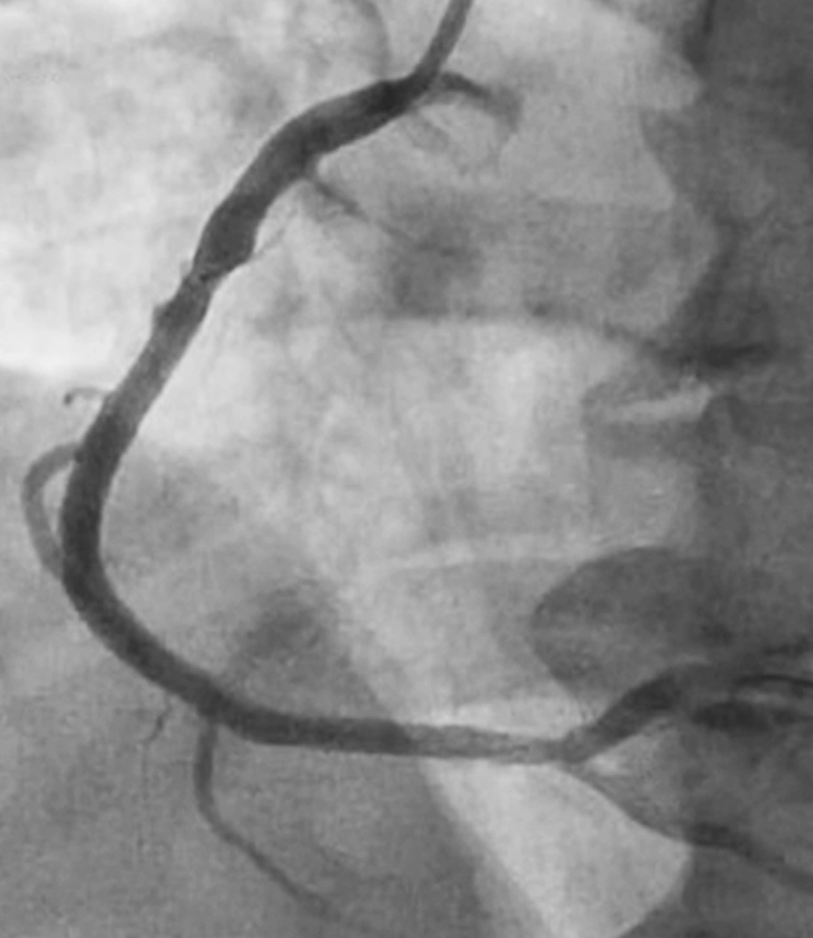 Angiogram of restored flow in right coronary artery after CAT RX clot removal
