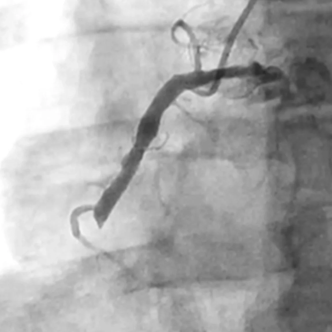 Angiogram of clot occlusion in right coronary artery before CAT RX intervention