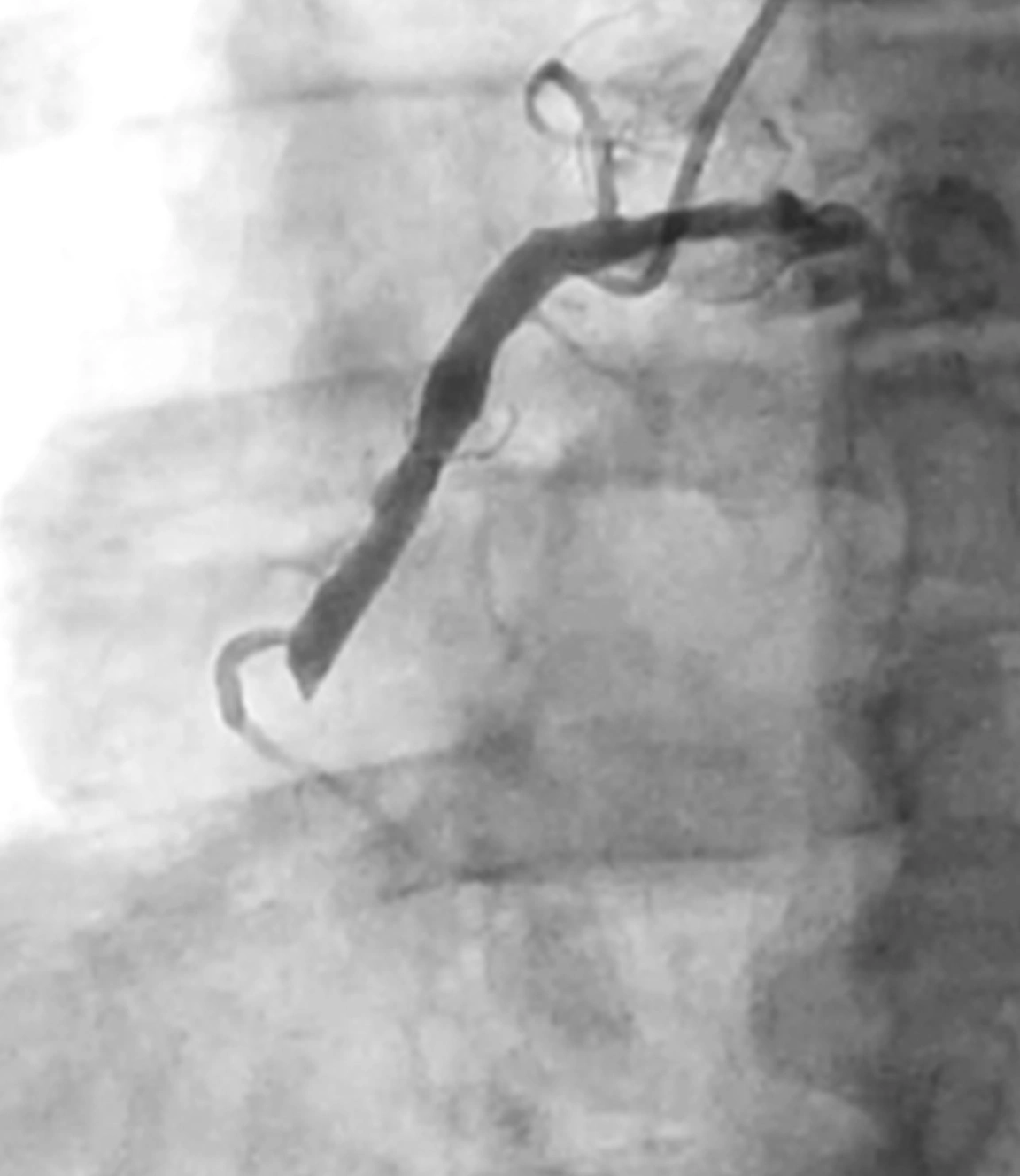 Angiogram of clot occlusion in right coronary artery before CAT RX intervention