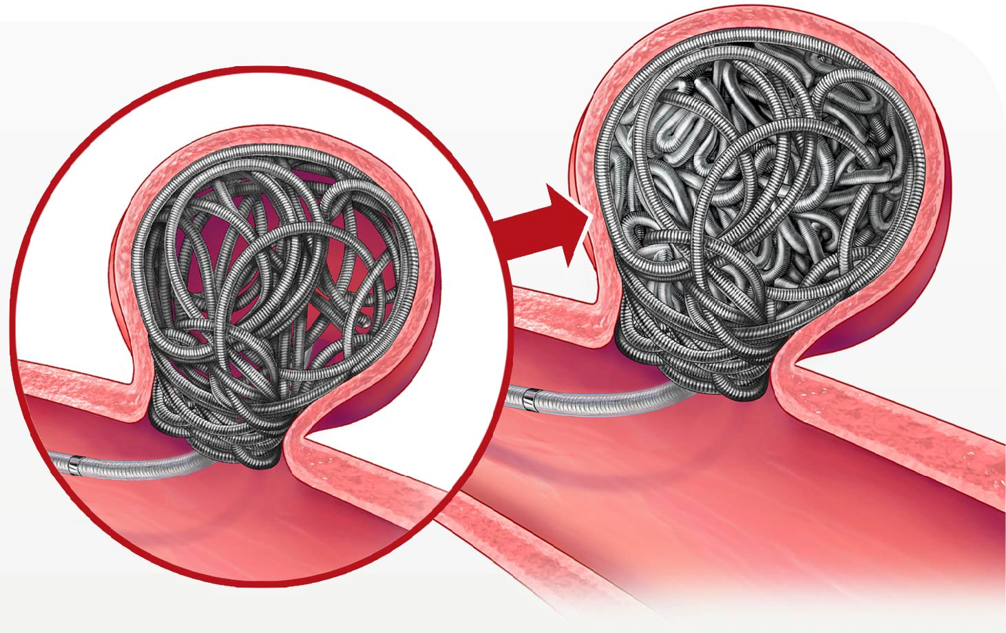 Illustration Ruby Coil System coiling and packing and aneurysm in a vessel within the body