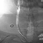 Animated Angiogram of BMX 96 tracking over a 6 F Select Catheter into the common carotid artery from the radial artery
