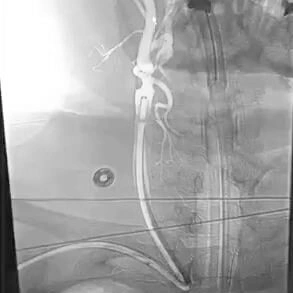 Angiogram of BMX 96 placed into the common carotid artery prior to stent placement