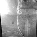 Angiogram of a carotid stent being delivered through BMX 96