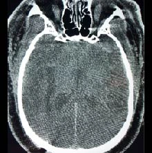 CT Scan post Intracerabral hemorrhage evacuation with Artemis