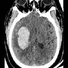 CT Scan of Intracerebral hemorrhage (ICH)