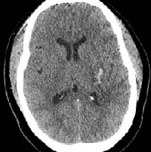 CT Scan post Intracerabral hemorrhage evacuation with Artemis