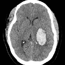 CT Scan of Intracerebral hemorrhage (ICH)
