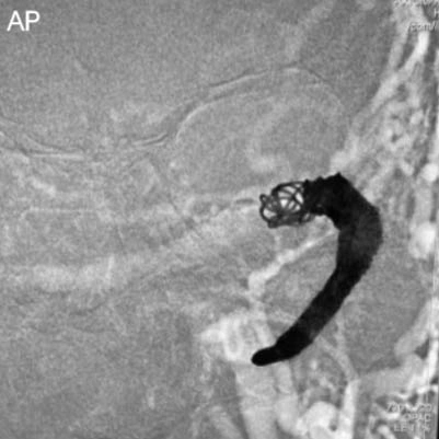 AP Angiogram of PC400 and PAC400 coil placement in dural AVF