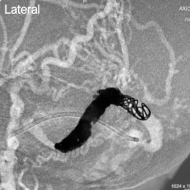 Lateral Angiogram of PC400 and PAC400 coil placement in dural AVF