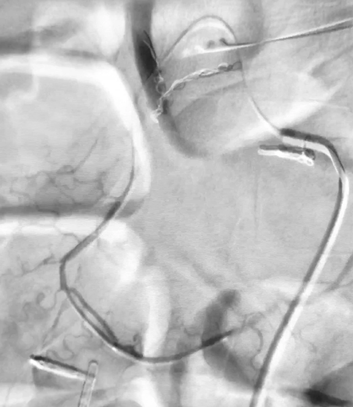 Angiogram of gastroduodenal artery prior to embolization