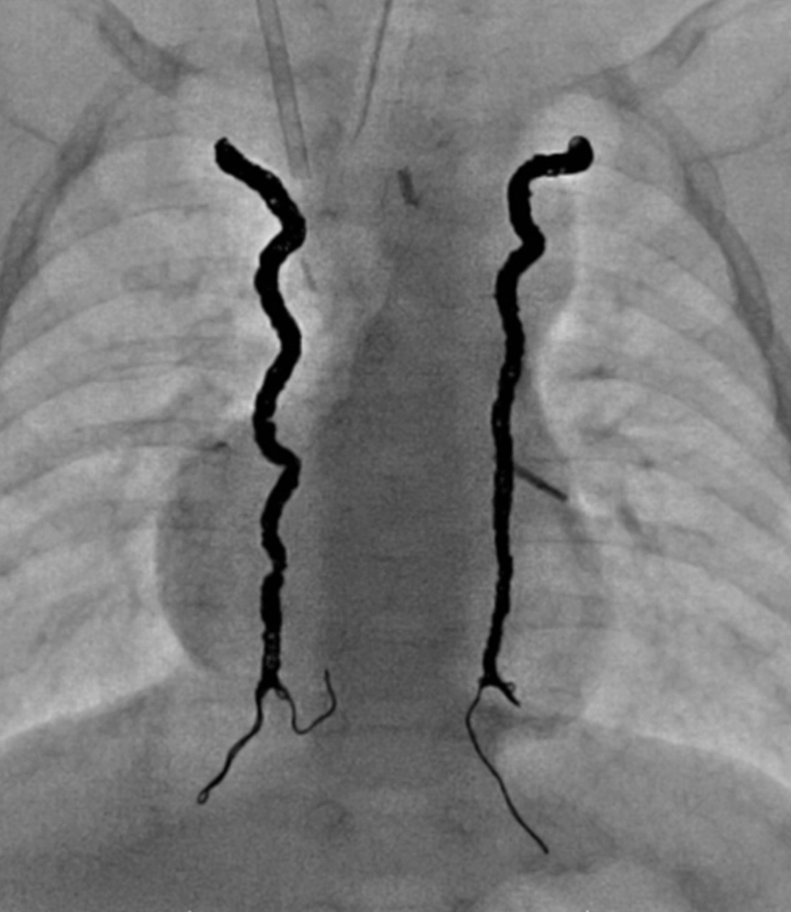 Angiogram of occluded aortopulmonary collaterals with LP coils