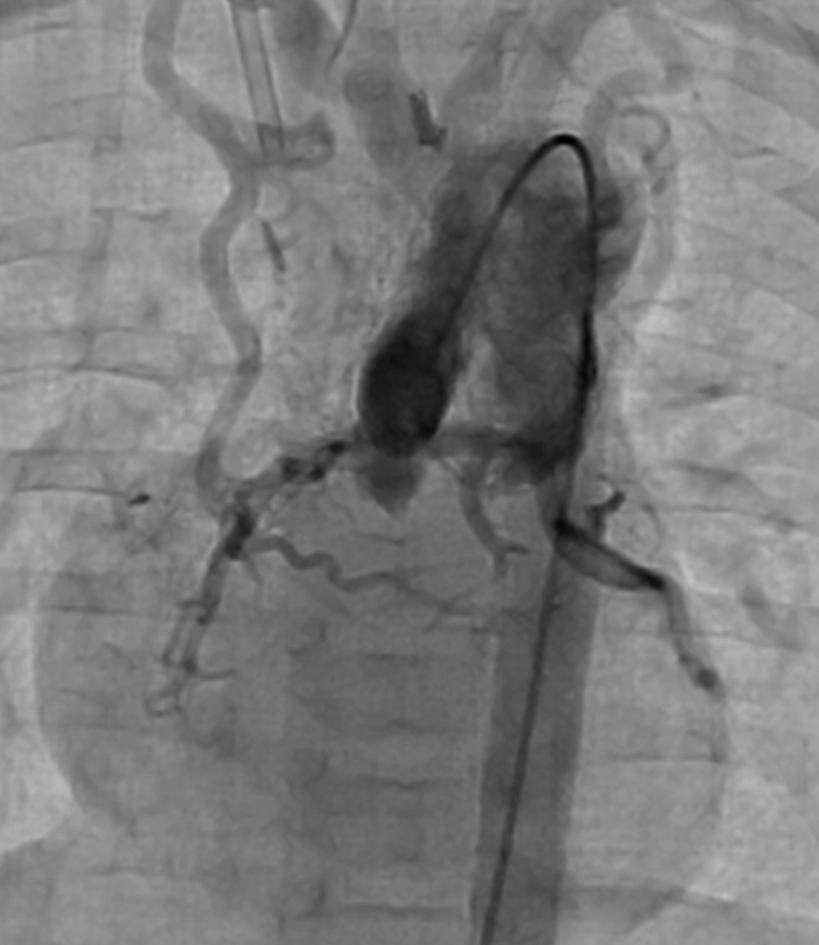 Angiogram of aortopulmonary collaterals