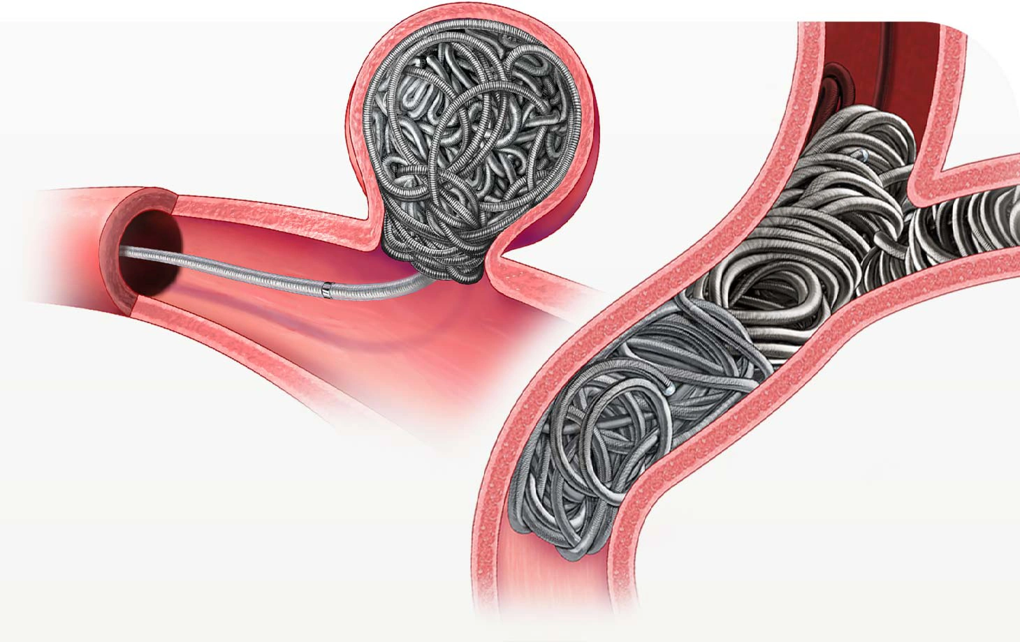 Illustration of Embolization coils within vessels of the body