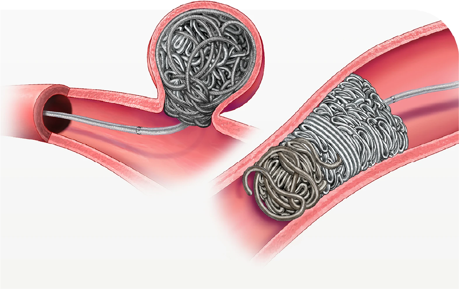 Embolization Coils in vessel illustration