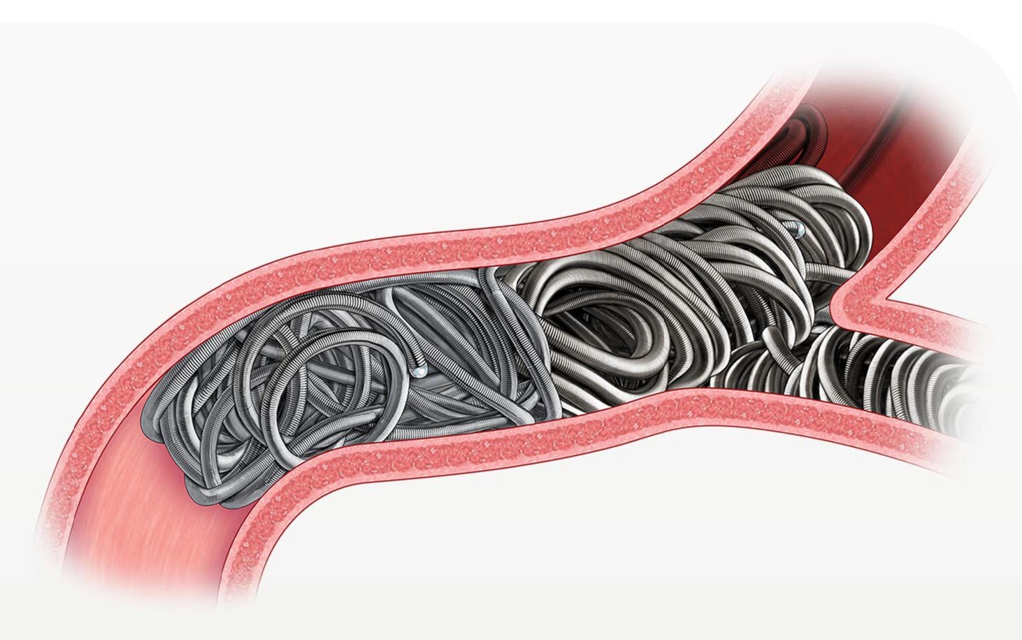 LP Coil System illustration of embolization coils in a vessel in the body