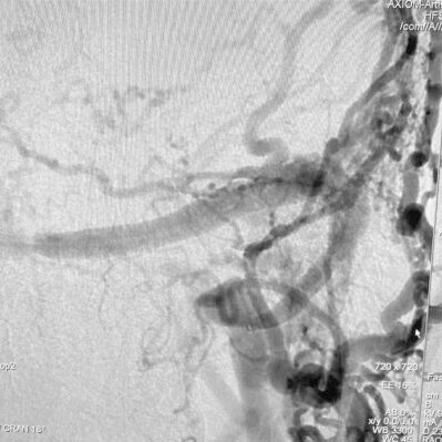 AP Angiogram of dural AVF prior to coiling